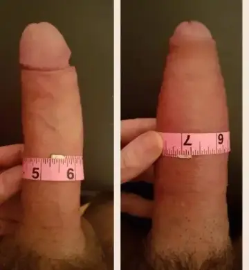 Androfill patient A — before and after dermal filler penis enlargement